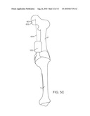 SENSING FORCE DURING PARTIAL AND TOTAL KNEE REPLACEMENT SURGERY diagram and image