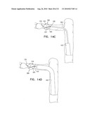 CATHETER INCLUDING A BENDABLE PORTION diagram and image