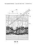 DEVICES AND METHODS FOR PERCUTANEOUS ENERGY DELIVERY diagram and image