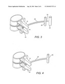 Method and apparatus for positioning implant between spinous processes diagram and image