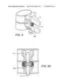 Method and apparatus for positioning implant between spinous processes diagram and image