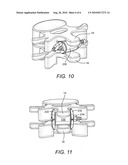 Method and apparatus for positioning implant between spinous processes diagram and image