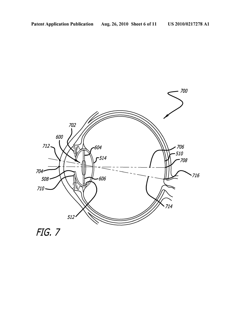REAL-TIME SURGICAL REFERENCE INDICIUM APPARATUS AND METHODS FOR INTRAOCULAR LENS IMPLANTATION - diagram, schematic, and image 07