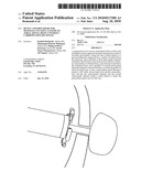 Device and procedure for minimally invasive closure of atrial septal defect without cardiopulmonary bypass diagram and image