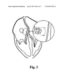 Device and procedure for minimally invasive closure of atrial septal defect without cardiopulmonary bypass diagram and image