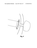 Device and procedure for minimally invasive closure of atrial septal defect without cardiopulmonary bypass diagram and image