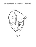 Device and procedure for minimally invasive closure of atrial septal defect without cardiopulmonary bypass diagram and image