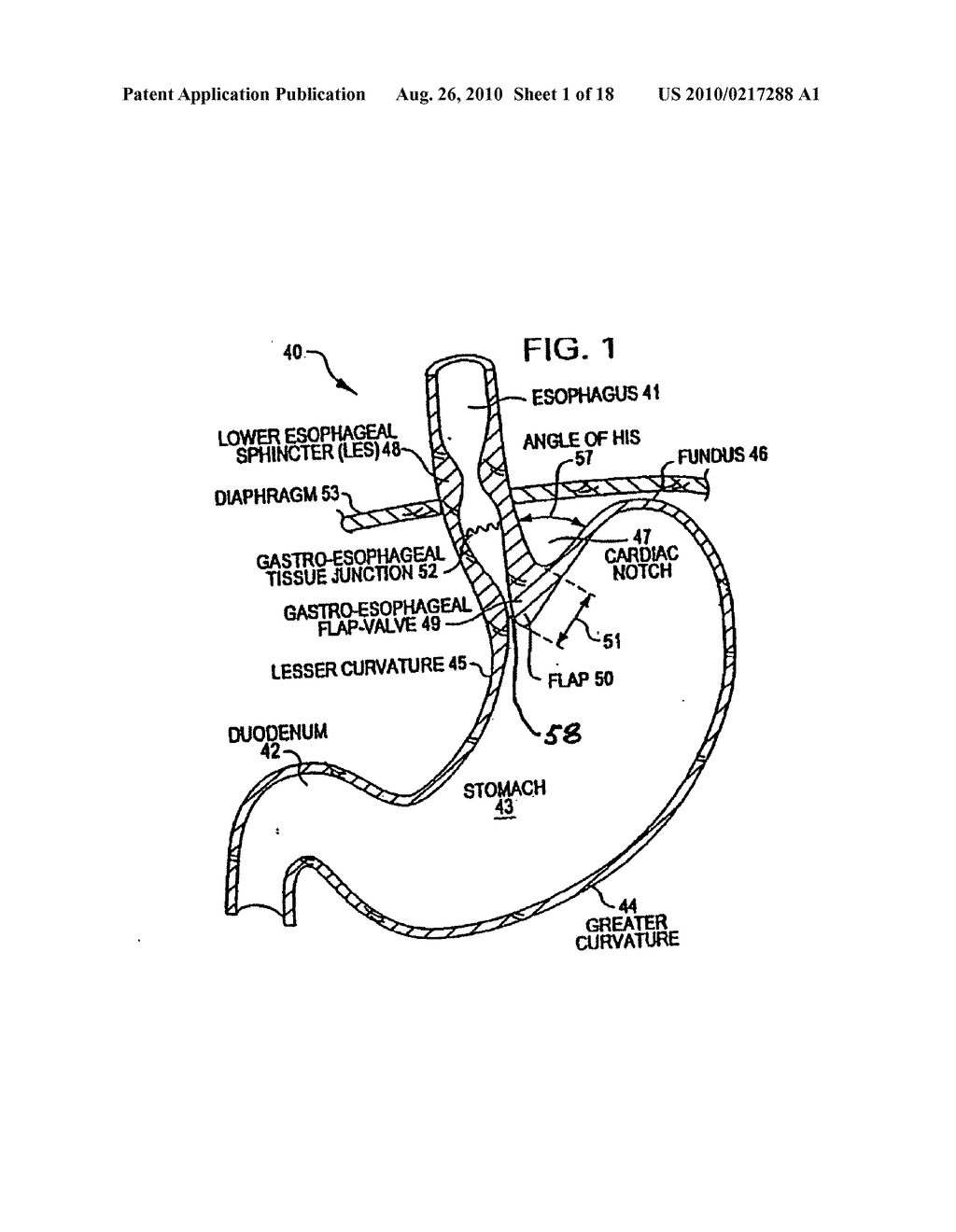 Transesophageal gastric reduction method and device for practicing same - diagram, schematic, and image 02