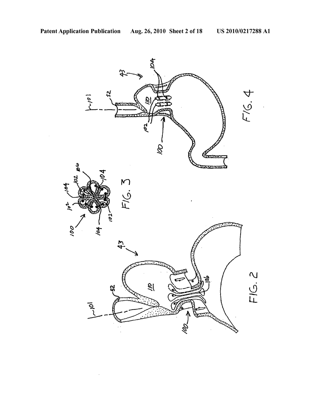 Transesophageal gastric reduction method and device for practicing same - diagram, schematic, and image 03