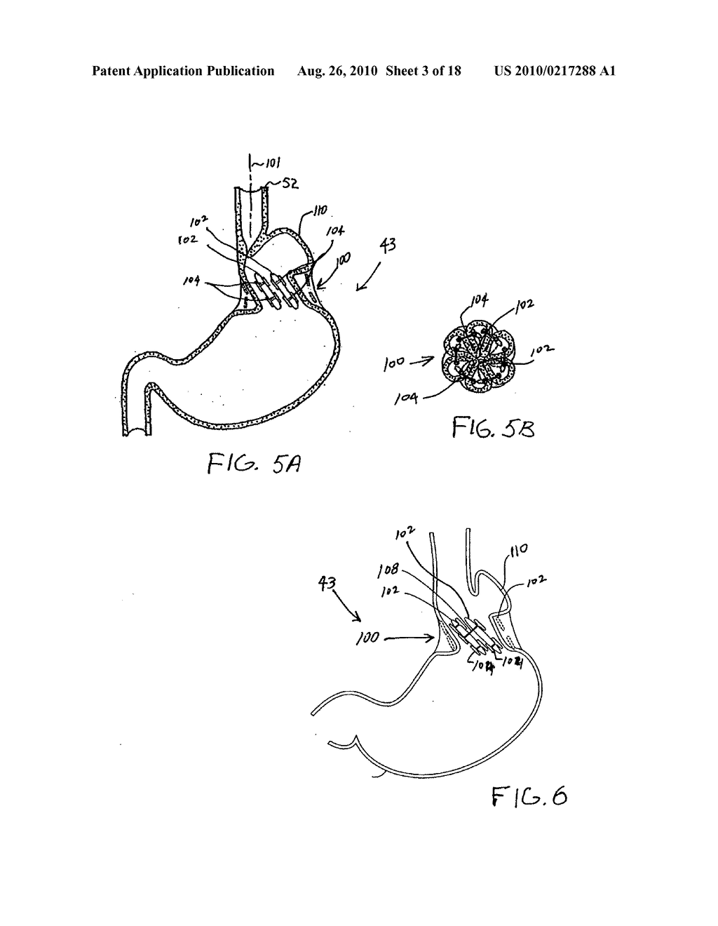 Transesophageal gastric reduction method and device for practicing same - diagram, schematic, and image 04