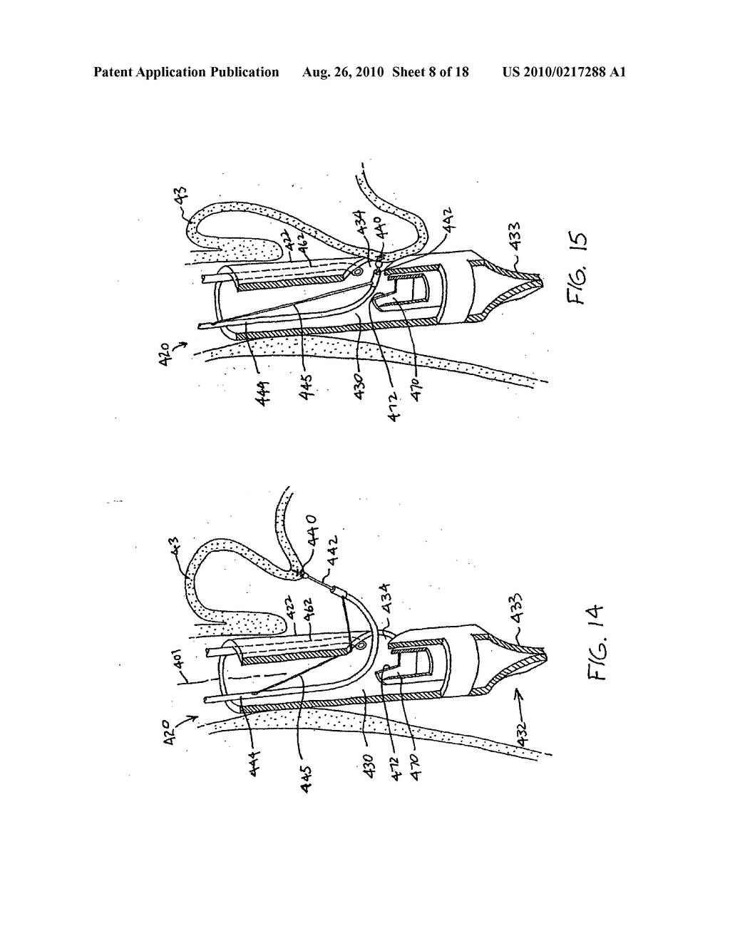 Transesophageal gastric reduction method and device for practicing same - diagram, schematic, and image 09