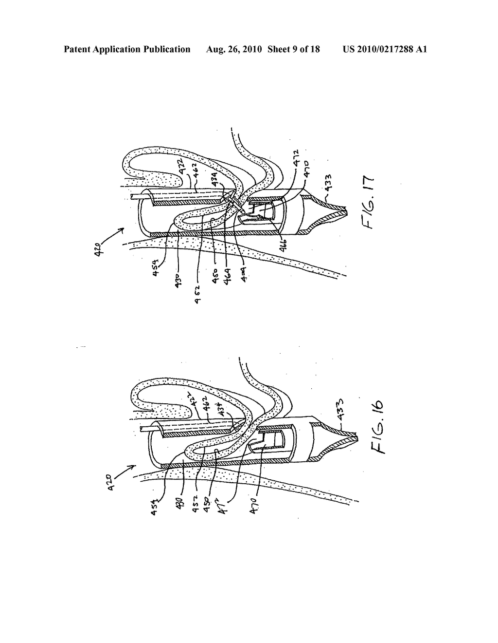 Transesophageal gastric reduction method and device for practicing same - diagram, schematic, and image 10