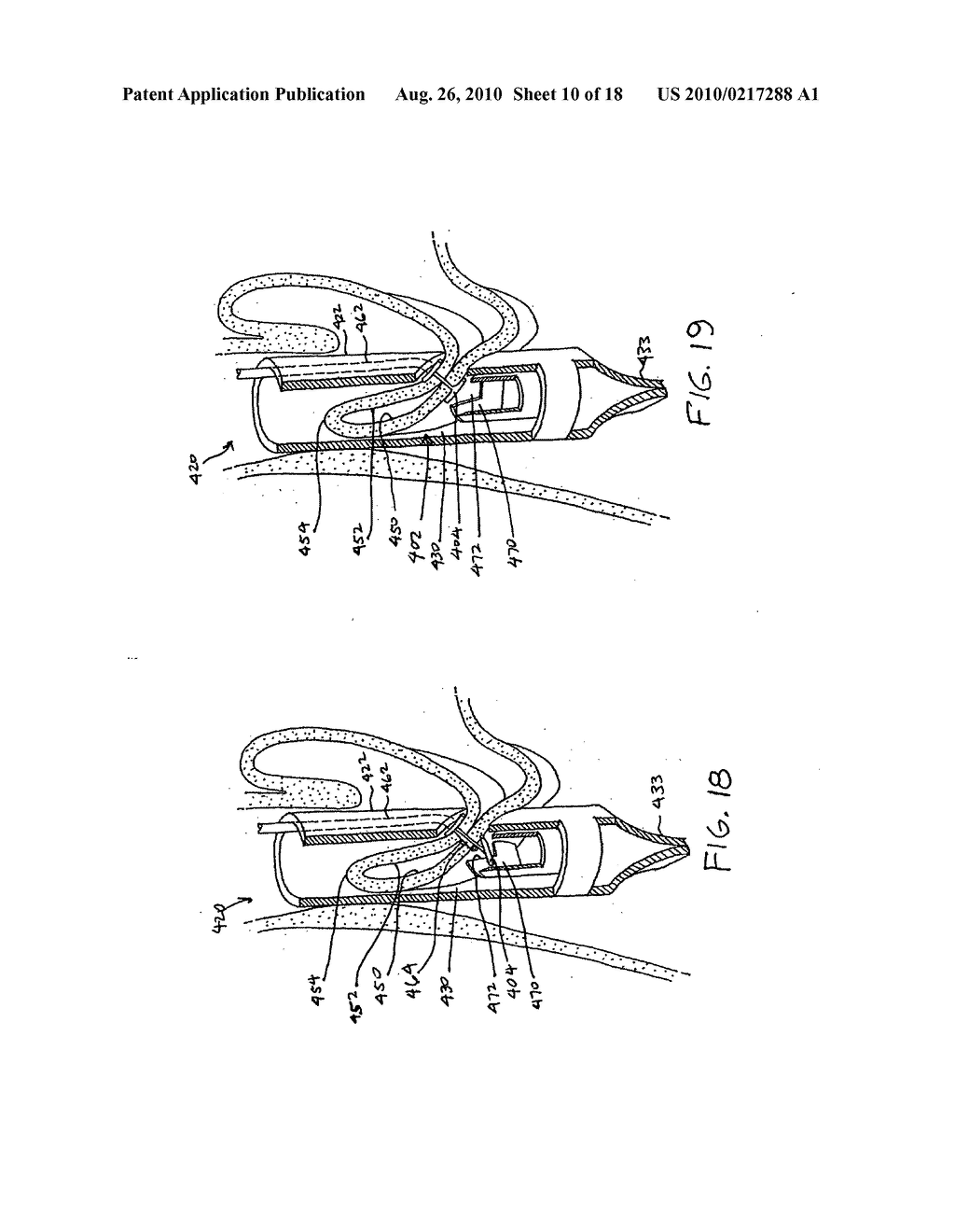 Transesophageal gastric reduction method and device for practicing same - diagram, schematic, and image 11