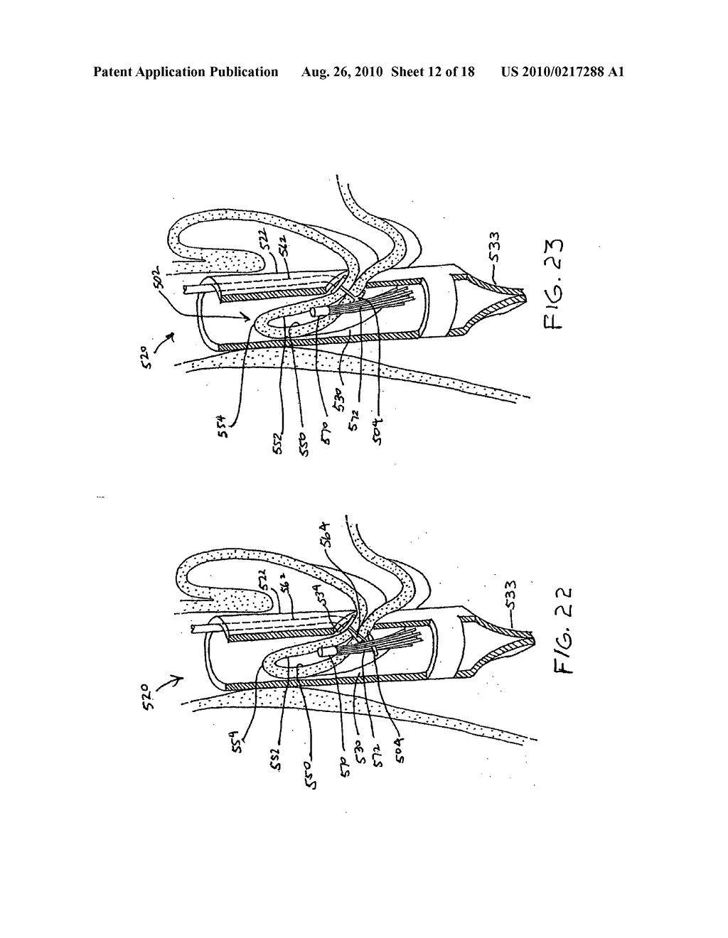 Transesophageal gastric reduction method and device for practicing same - diagram, schematic, and image 13