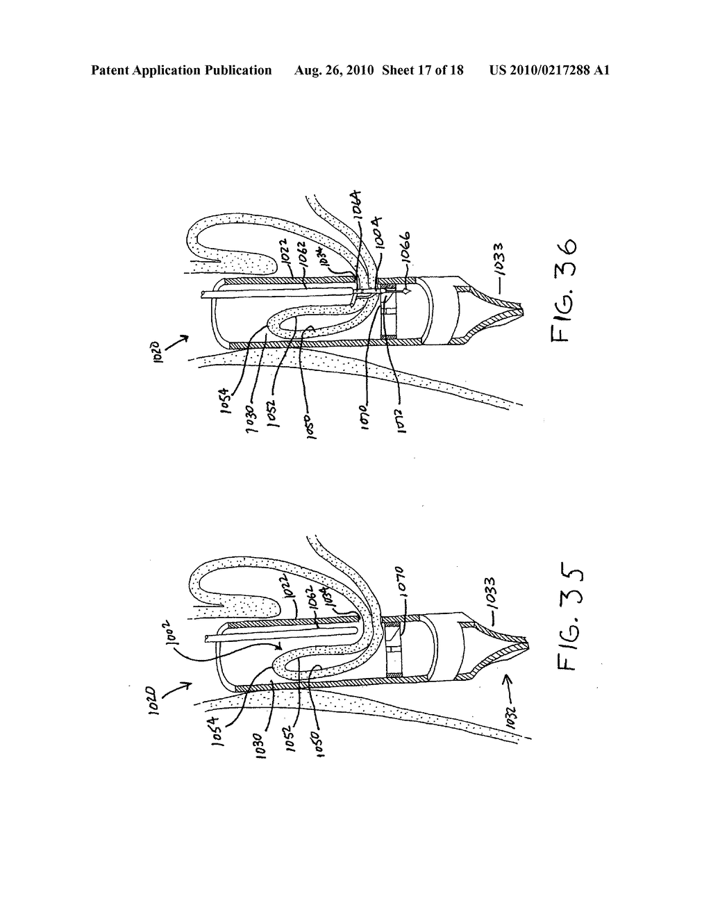 Transesophageal gastric reduction method and device for practicing same - diagram, schematic, and image 18