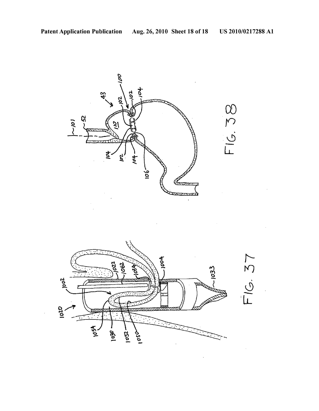 Transesophageal gastric reduction method and device for practicing same - diagram, schematic, and image 19