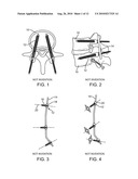 EXPANDABLE SPINAL SUPPORT DEVICE WITH ATTACHABLE MEMBERS AND METHODS OF USE diagram and image