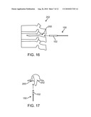 EXPANDABLE SPINAL SUPPORT DEVICE WITH ATTACHABLE MEMBERS AND METHODS OF USE diagram and image