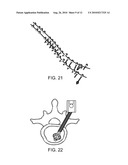 EXPANDABLE SPINAL SUPPORT DEVICE WITH ATTACHABLE MEMBERS AND METHODS OF USE diagram and image