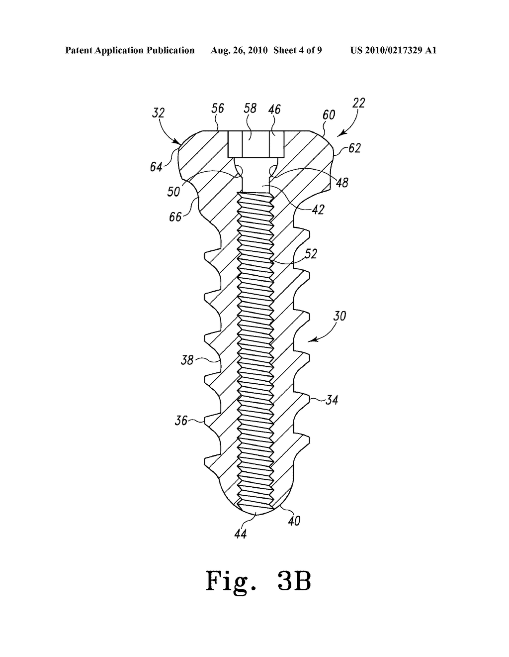 BONE SCREW - diagram, schematic, and image 05