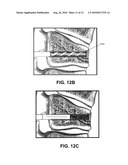 SELF-EXPANDING BONE STABILIZATION DEVICES diagram and image