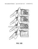 SELF-EXPANDING BONE STABILIZATION DEVICES diagram and image