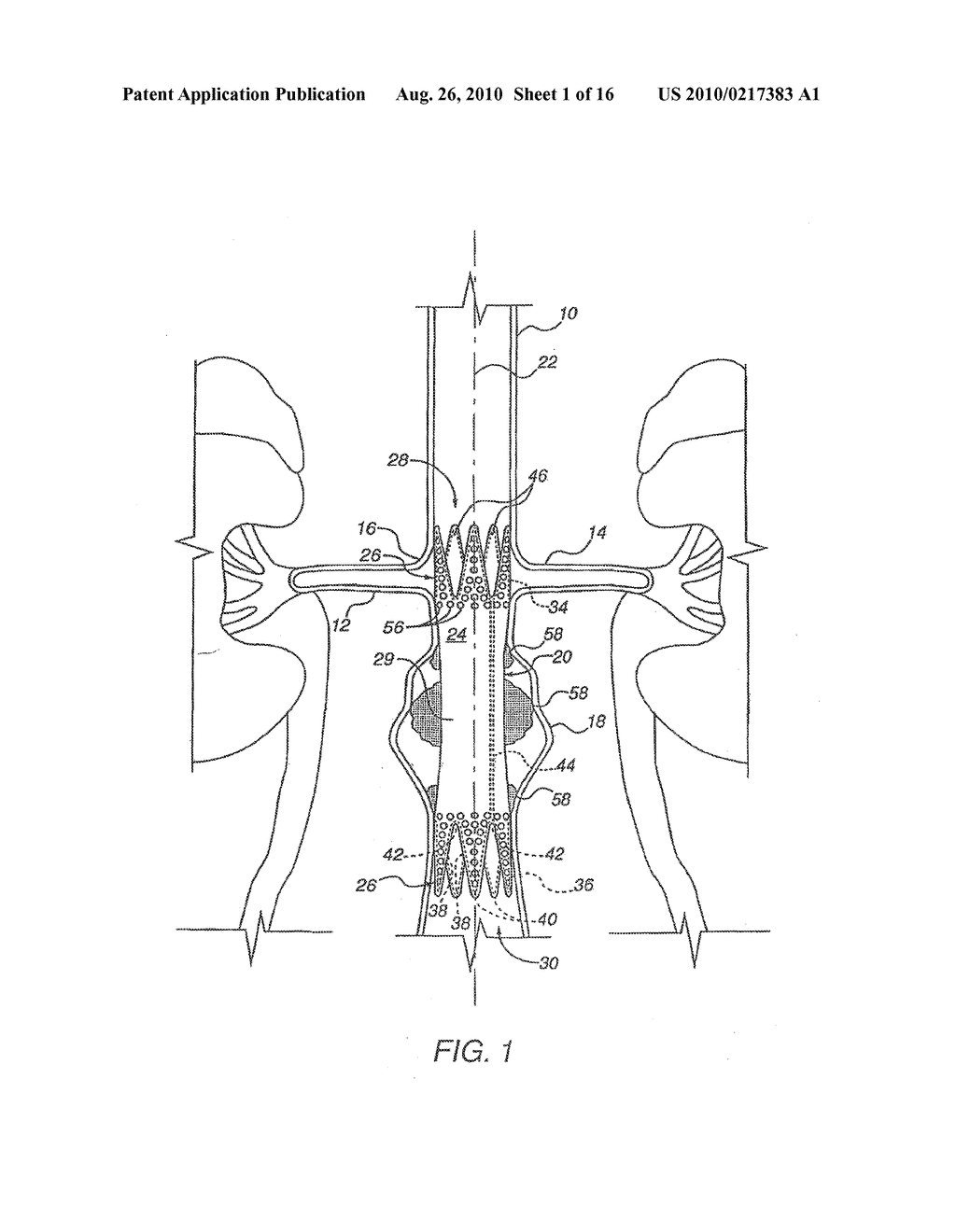 Apparatus for Engrafting a Blood Vessel - diagram, schematic, and image 02