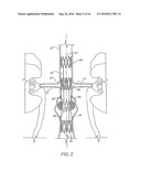 Apparatus for Engrafting a Blood Vessel diagram and image