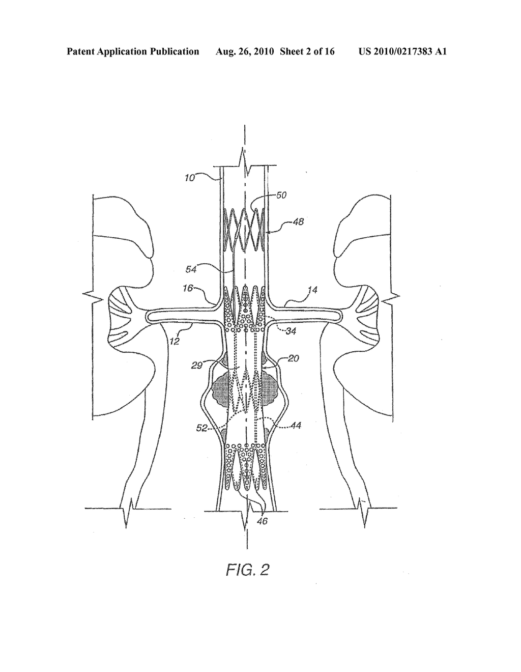 Apparatus for Engrafting a Blood Vessel - diagram, schematic, and image 03