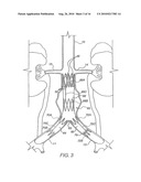 Apparatus for Engrafting a Blood Vessel diagram and image