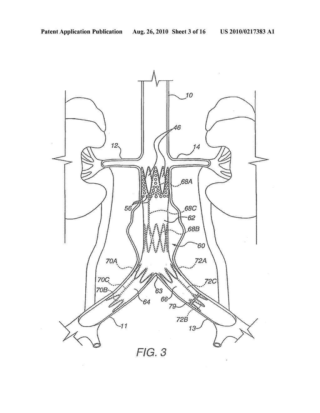 Apparatus for Engrafting a Blood Vessel - diagram, schematic, and image 04