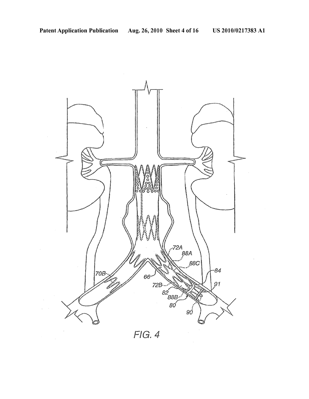 Apparatus for Engrafting a Blood Vessel - diagram, schematic, and image 05