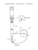 Apparatus for Engrafting a Blood Vessel diagram and image