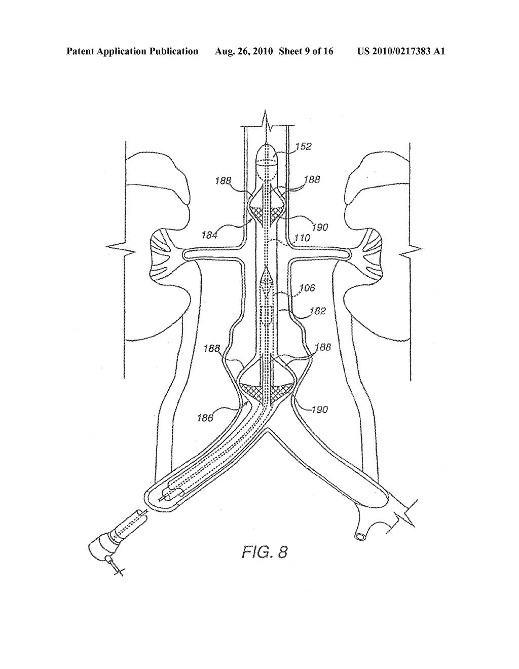 Apparatus for Engrafting a Blood Vessel - diagram, schematic, and image 10