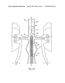 Apparatus for Engrafting a Blood Vessel diagram and image