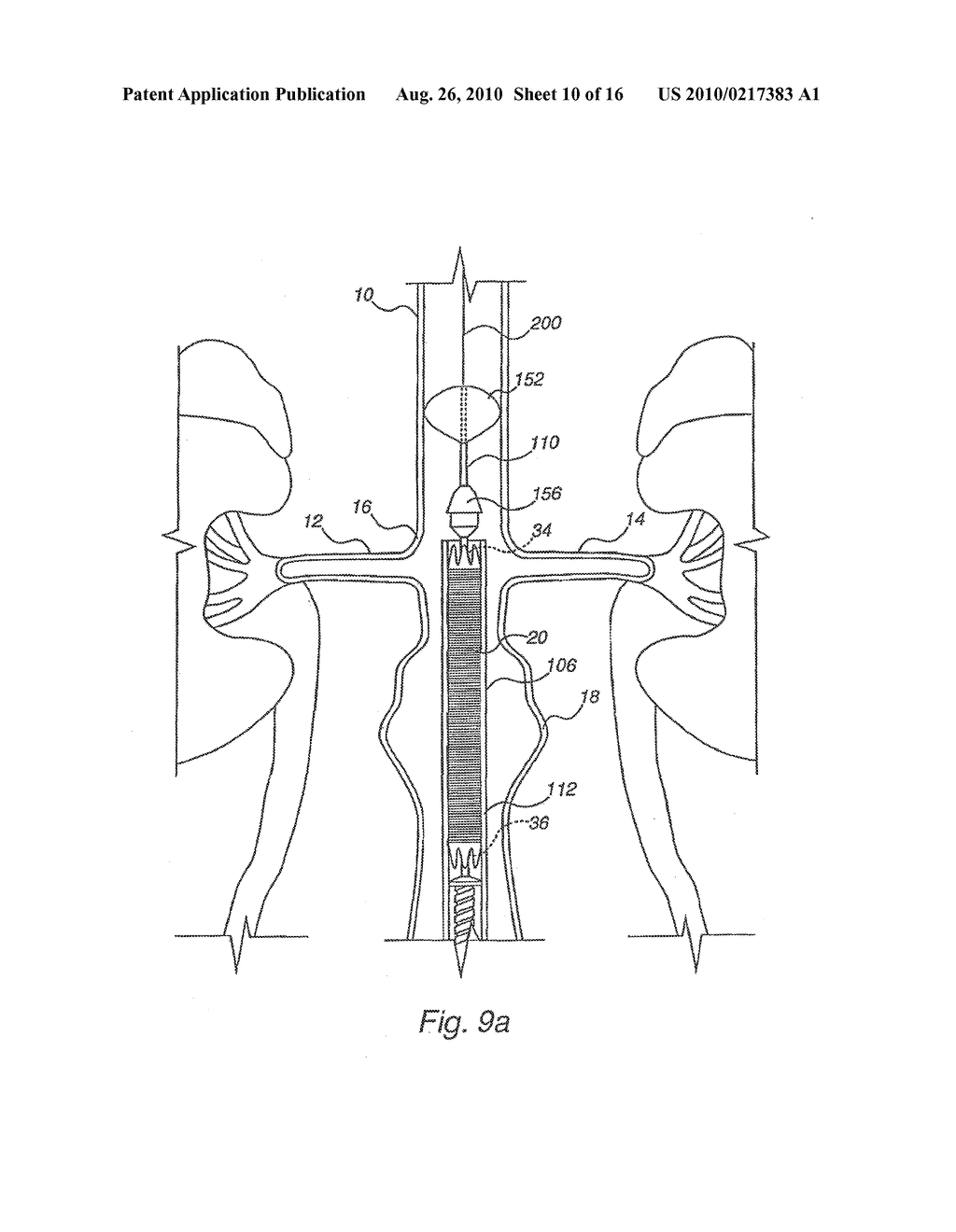 Apparatus for Engrafting a Blood Vessel - diagram, schematic, and image 11