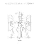 Apparatus for Engrafting a Blood Vessel diagram and image