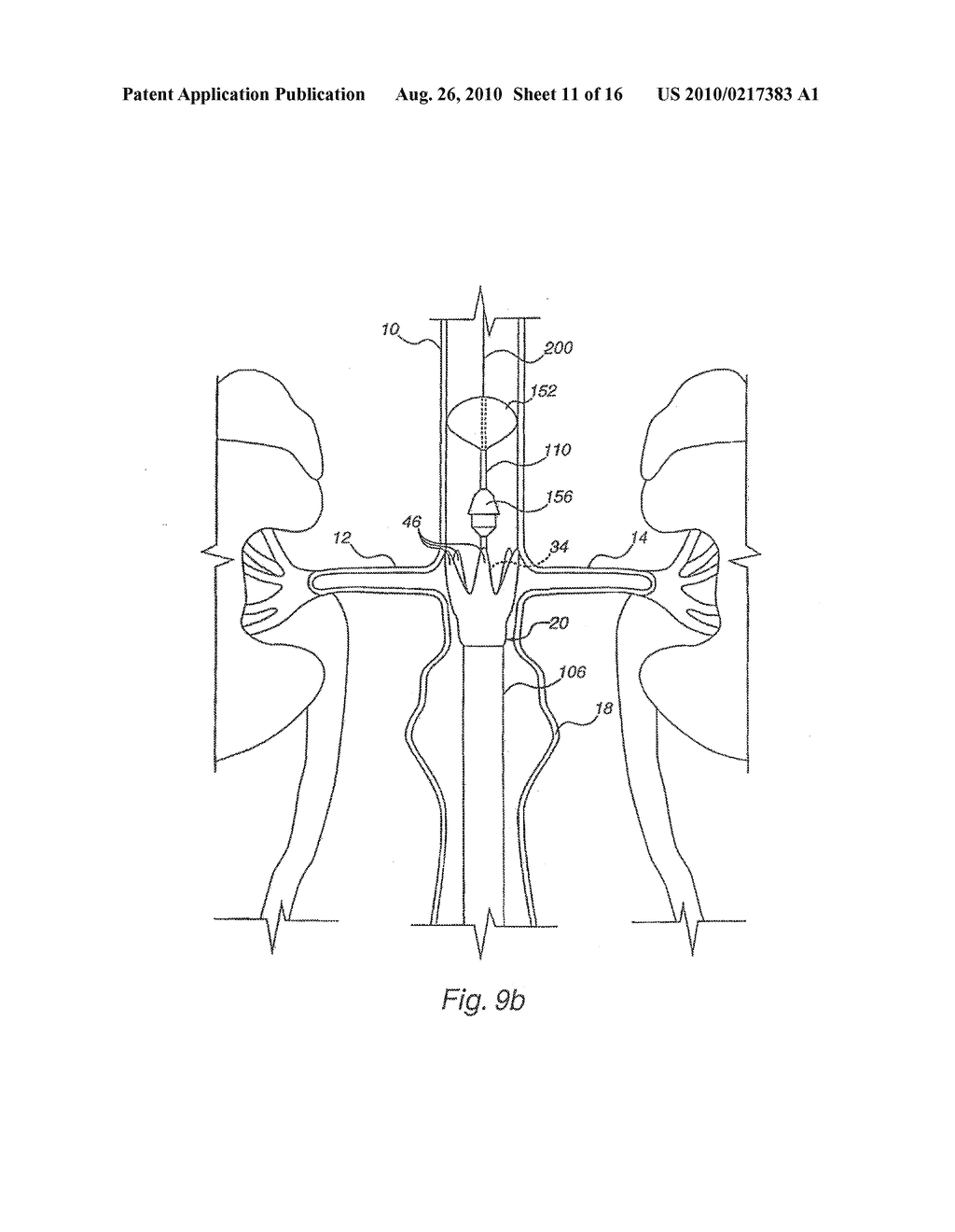 Apparatus for Engrafting a Blood Vessel - diagram, schematic, and image 12