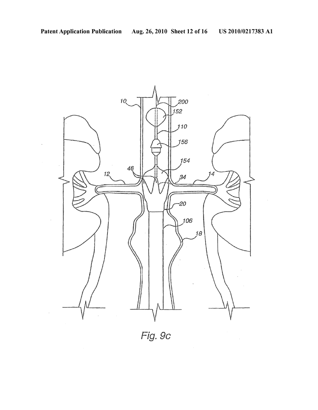 Apparatus for Engrafting a Blood Vessel - diagram, schematic, and image 13