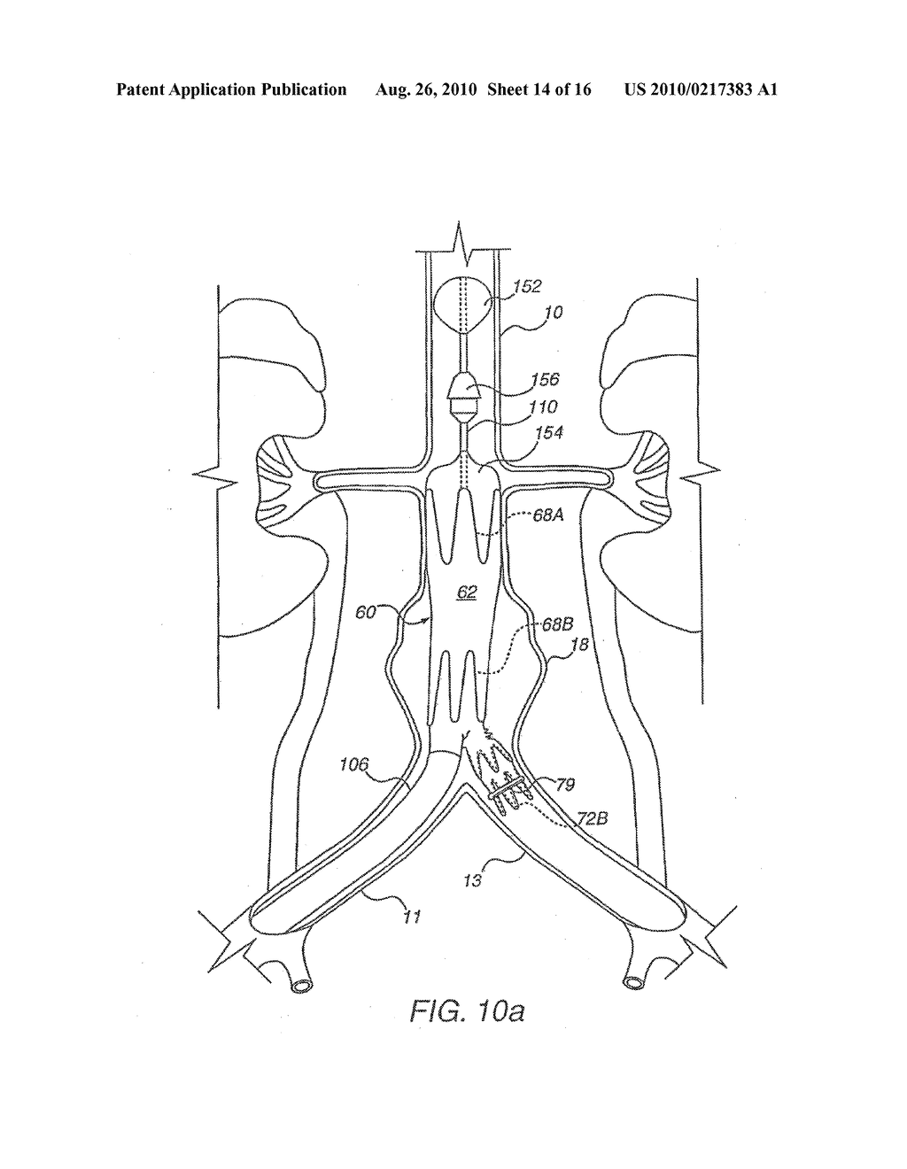 Apparatus for Engrafting a Blood Vessel - diagram, schematic, and image 15