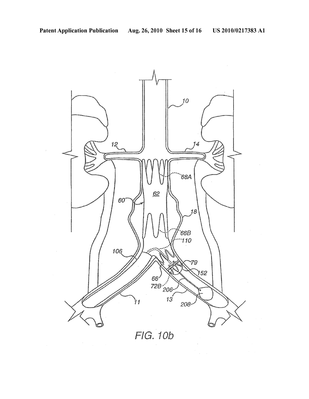 Apparatus for Engrafting a Blood Vessel - diagram, schematic, and image 16