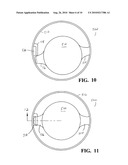 Intraocular lens diagram and image