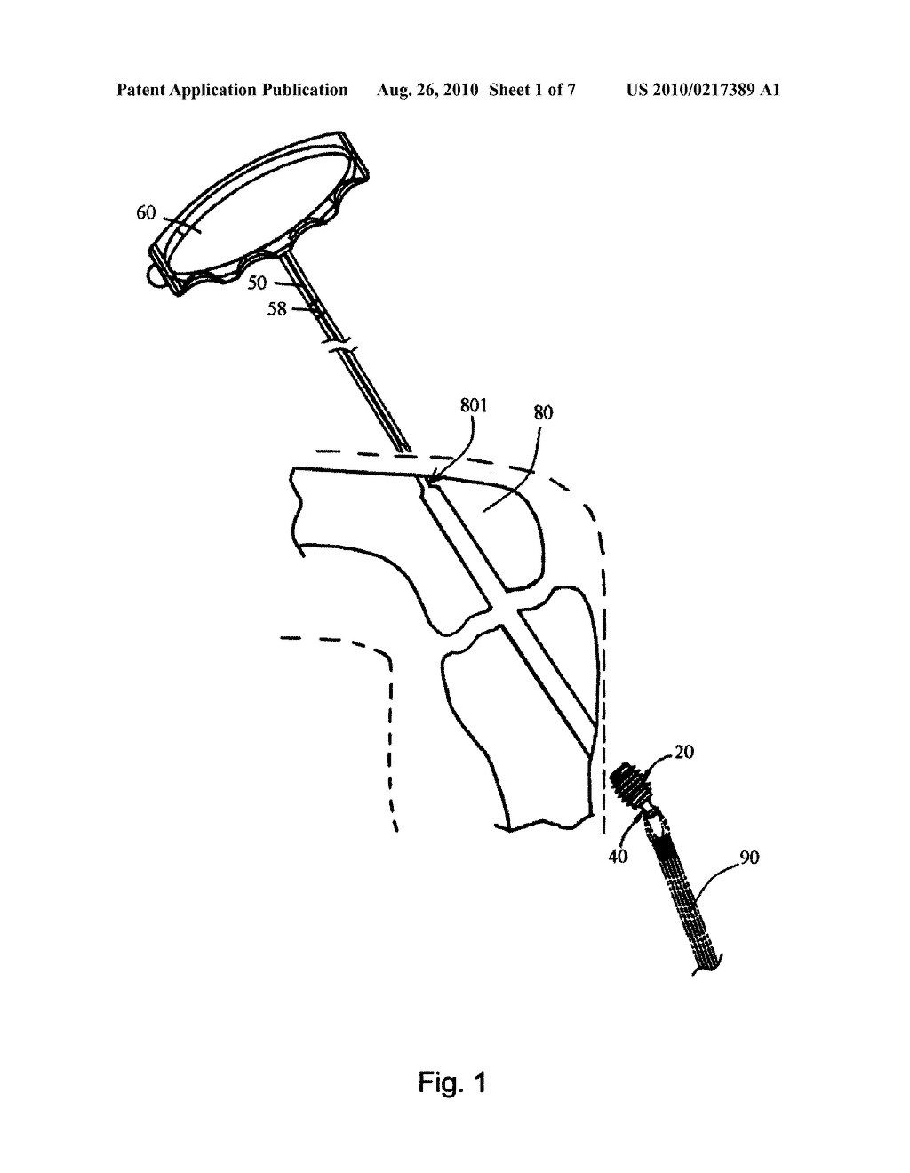 GRAFT ATTACHMENT DEVICE FOR LIGAMENT RECONSTRUCTION - diagram, schematic, and image 02