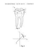 RESTORATION, RESTORATION COMPONENTS, AND METHODS OF MAKING A DENTAL RESTORATION diagram and image