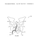 SYSTEMS AND METHODS FOR DELIVERING A MEDICAL IMPLANT TO AN ANATOMICAL LOCATION IN A PATIENT diagram and image