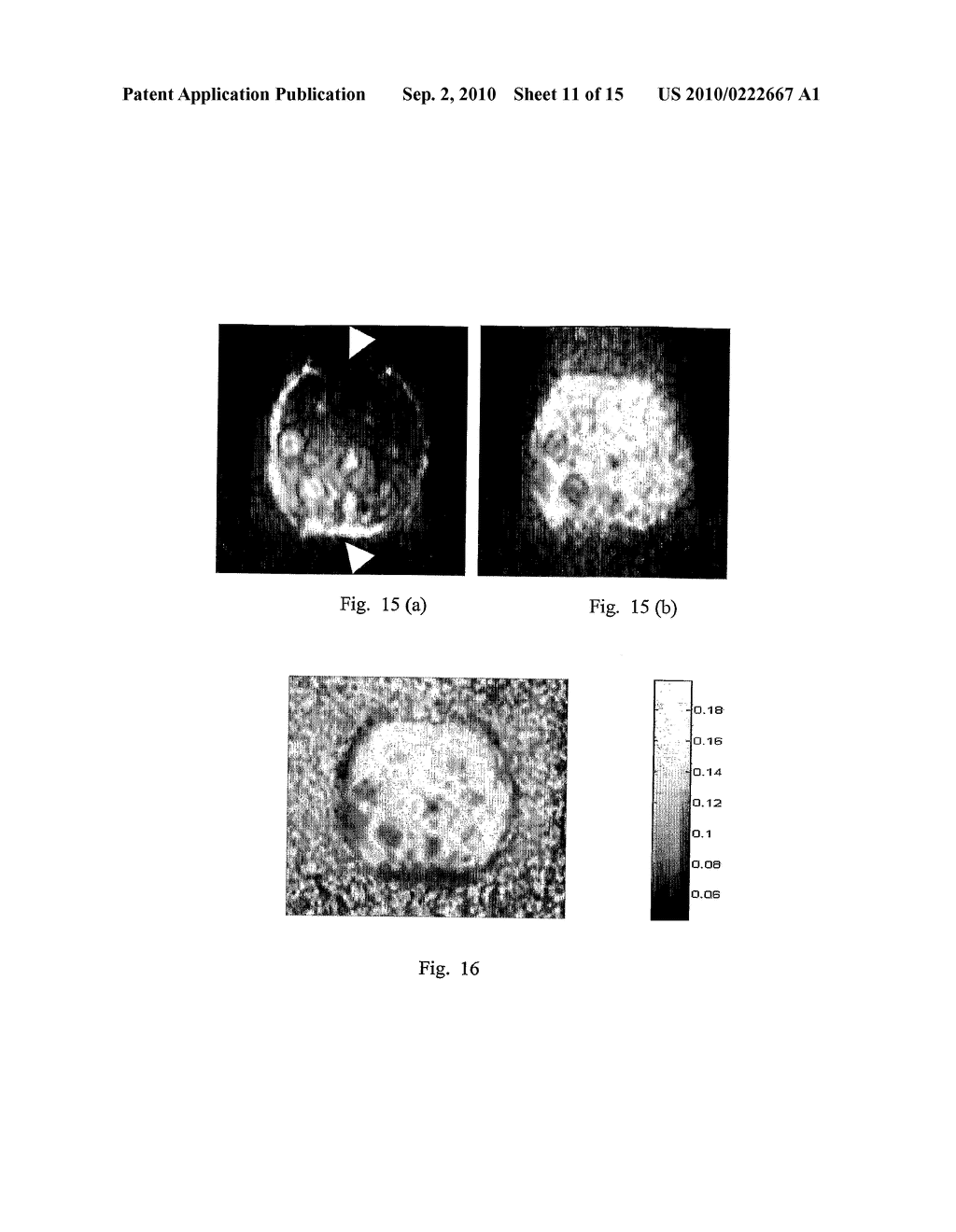 COMPRESSION DEVICE FOR ENHANCING NORMAL/ABNORMAL TISSUE CONTRAST IN MRI INCLUDING DEVICES AND METHODS RELATED THERETO - diagram, schematic, and image 12