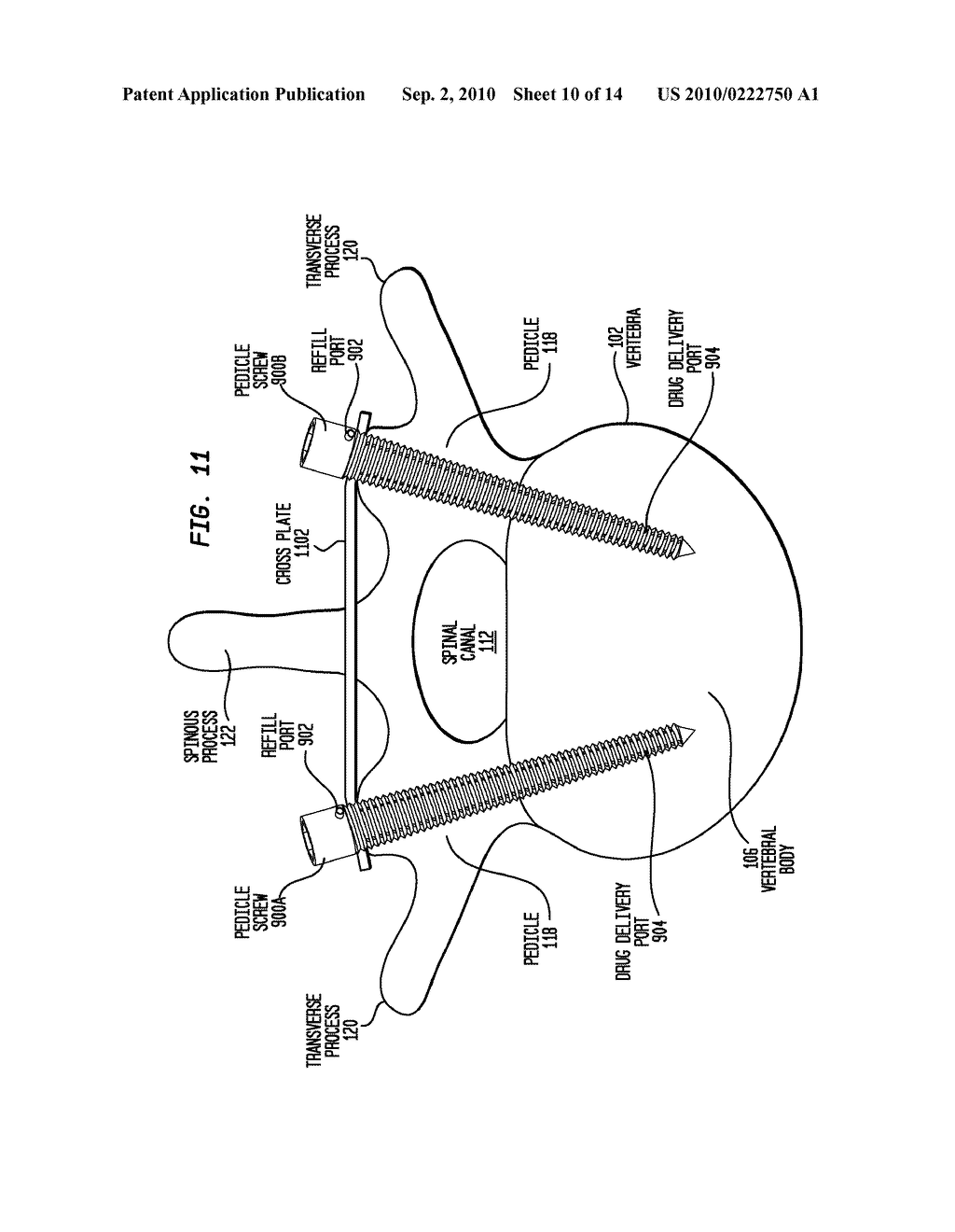 REPLENISHABLE DRUG DELIVERY IMPLANT FOR BONE AND CARTILAGE - diagram, schematic, and image 11