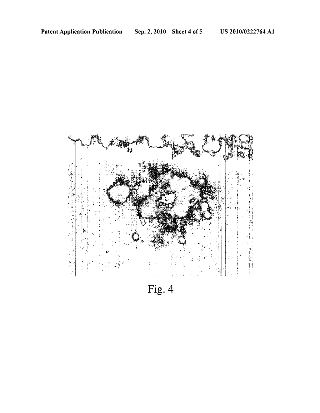 Intracranial Catheter and Methods of Use - diagram, schematic, and image 05