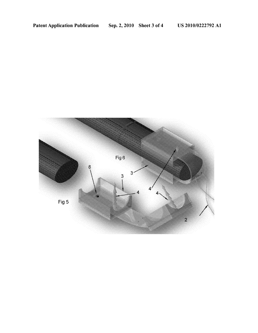 METHOD AND APPARATUS FOR A SOFT TISSUE GRASPING DEVICE - diagram, schematic, and image 04