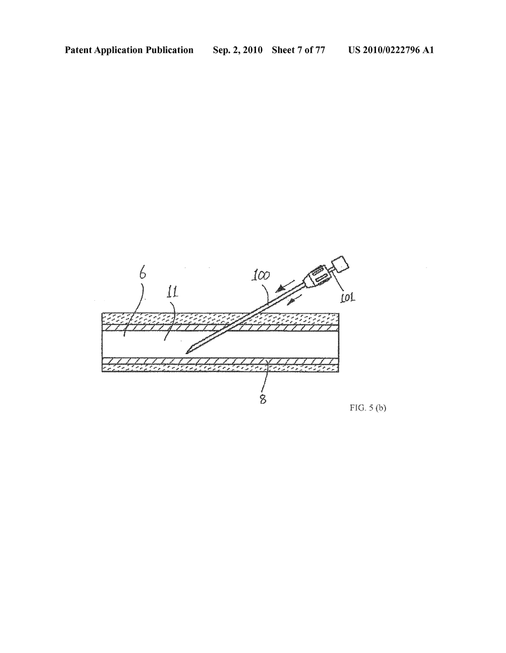 INTERVENTIONAL MEDICAL CLOSURE DEVICE - diagram, schematic, and image 08